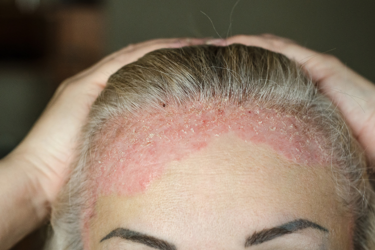 Natural Solutions for Eczema: How to Heal Your Skin Without Harsh Chemicals