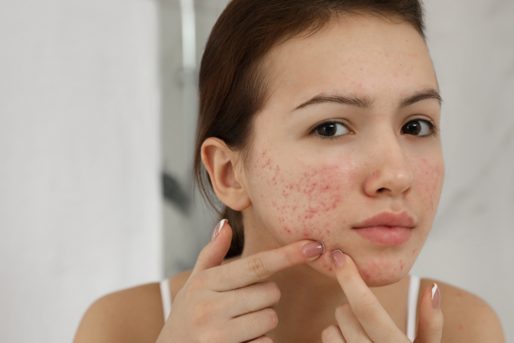 Natural Acne Solutions for Clearer, Healthier Skin
